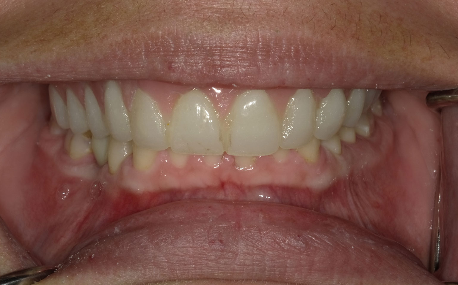 1a-Implant-supported-fixed-denture-hybrid-After
