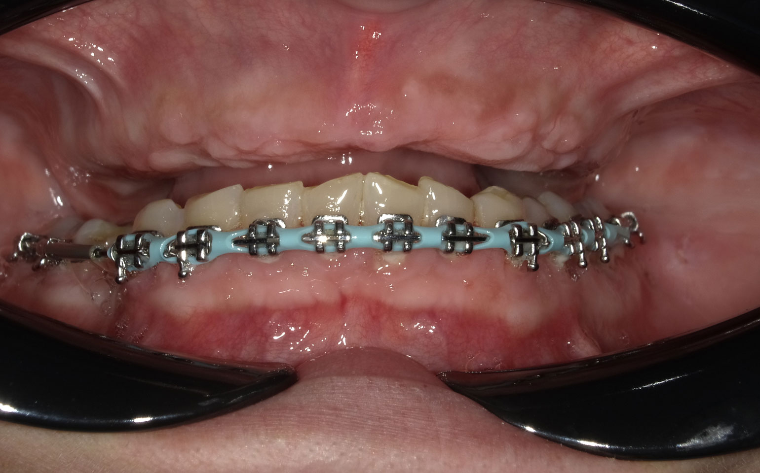 1b-Implant-supported-fixed-denture-hybrid-before