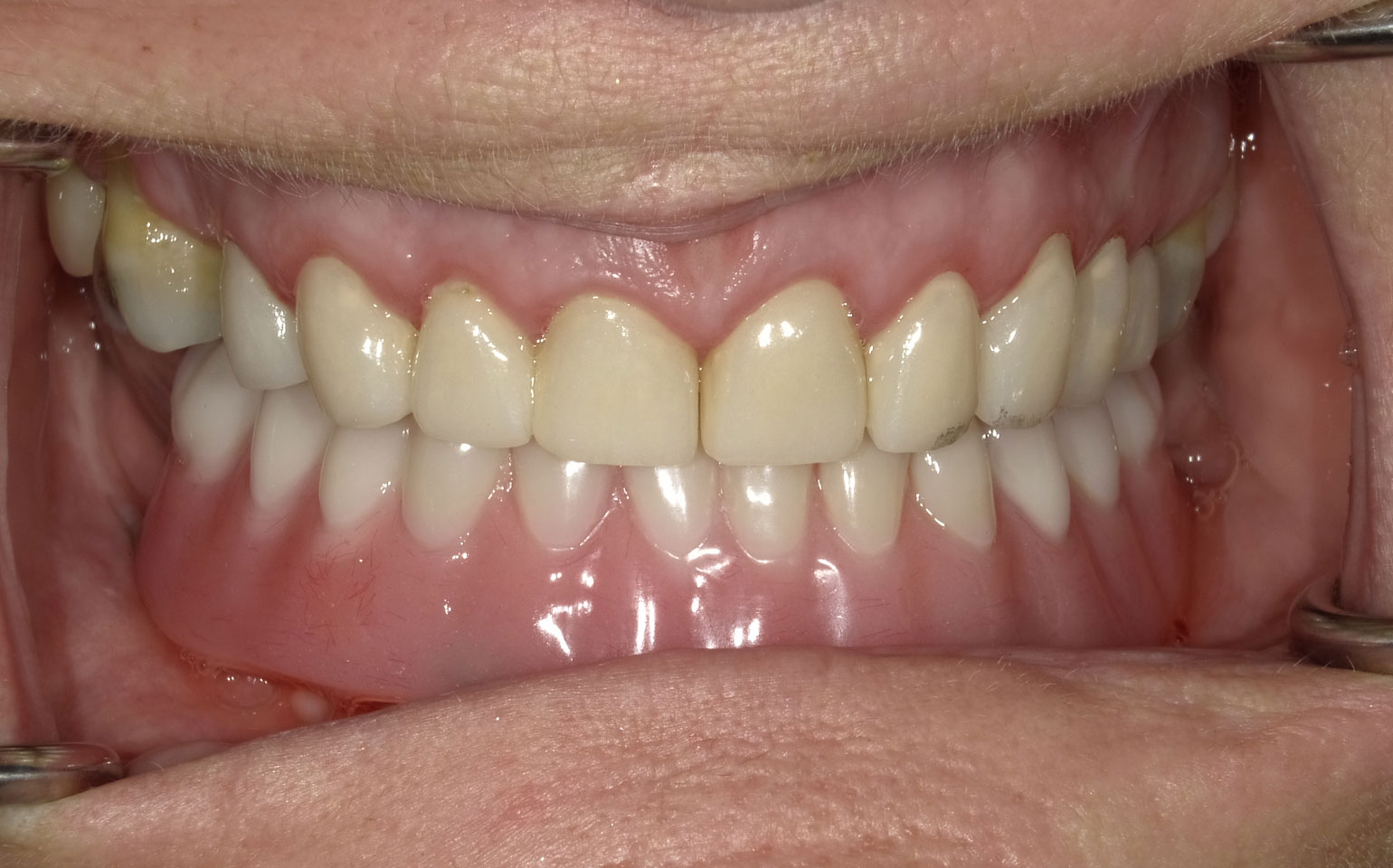 Smile-make-over-with-lower-implant-denture-After
