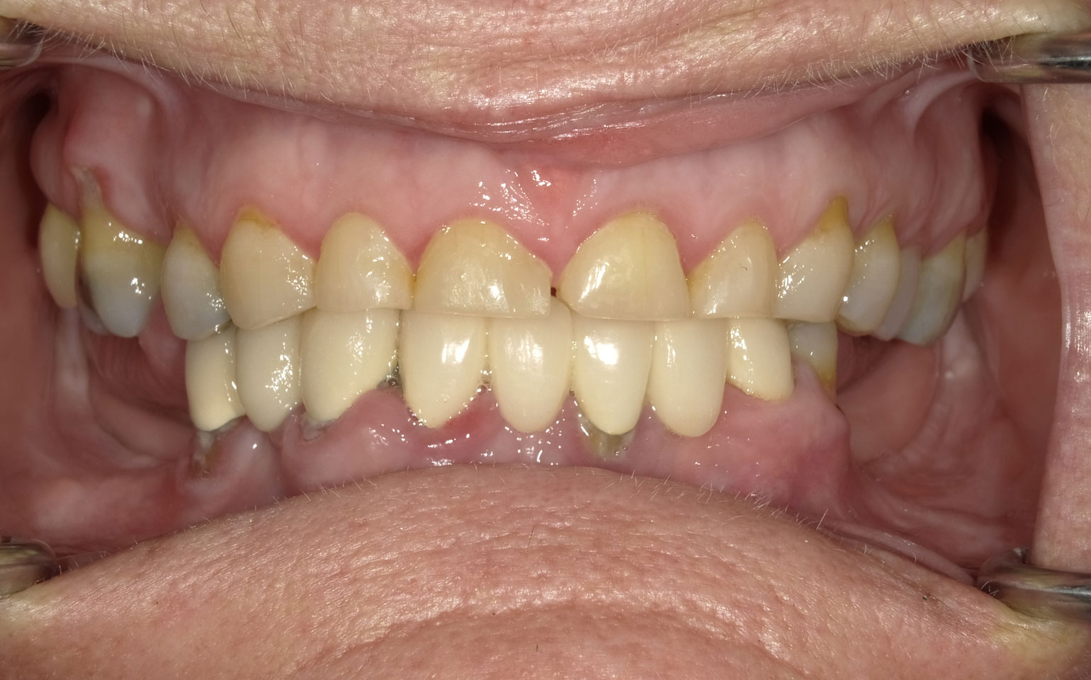 Smile-make-over-with-lower-implant-denture-Before
