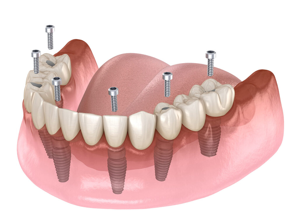 All-on-4 Dental Implant Solution – Full Arch Restoration in Cocoa Beach