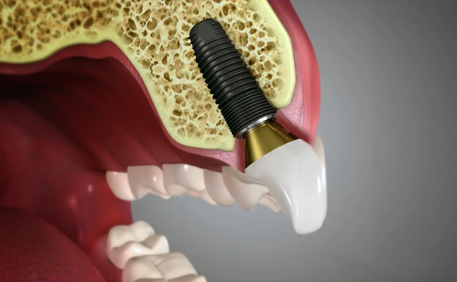 Durable Dental Implants for Missing Teeth Replacement in Cocoa Beach