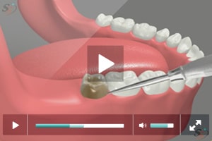 Mandibular Erupted Tooth Third Molar Extraction by Dental Expert