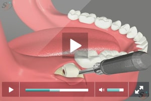 Horizontal Third Molar Extraction Procedure at Cocoa Beach