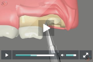 Maxillary Third Molar Extraction Procedure Performed Safely