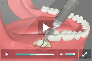 Mesio-Angular Third Molar Extraction Case Study