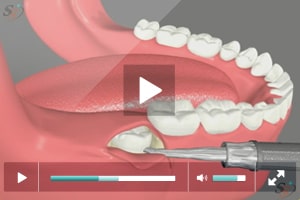 Vertical Third Molar Extraction Performed by Skilled Dentist