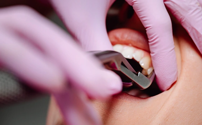 Tooth Extraction Procedures at Implants Cocoa Beach