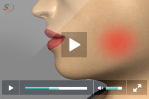 Reasons for Third Molar Extraction – Expert Advice from Implants Cocoa Beach